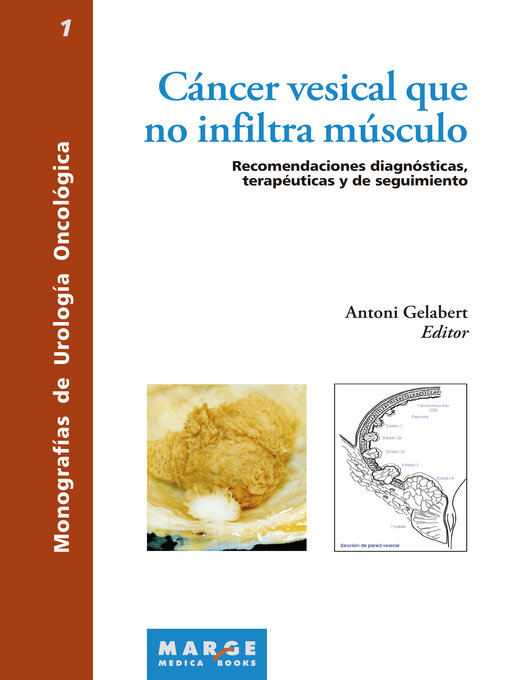 Title details for Cáncer vesical que no infiltra músculo by Antoni Gelabert Mas - Available